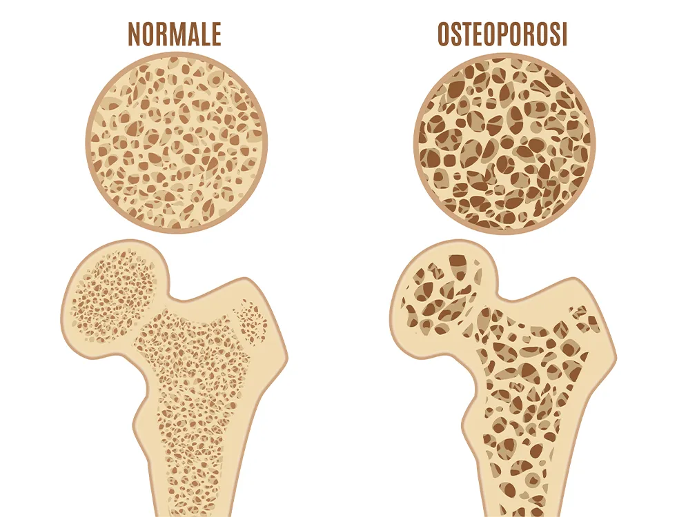 Osteoporosi Villa Donatello